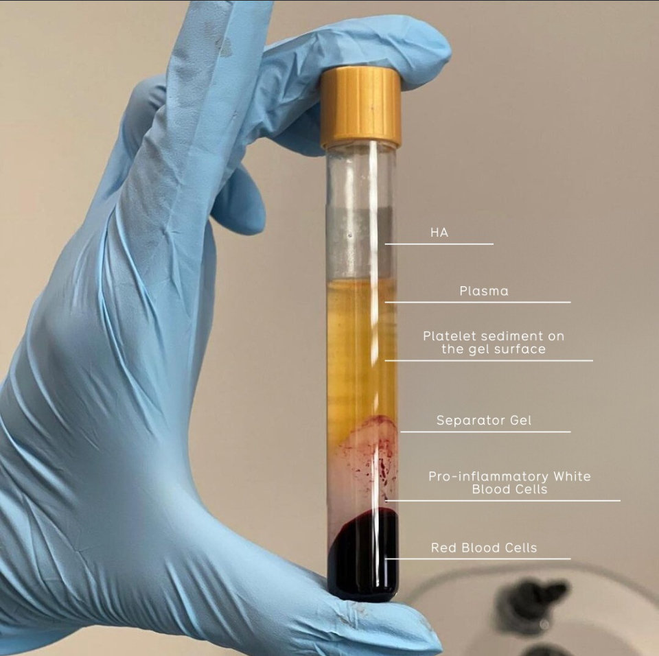 PRP Treatment